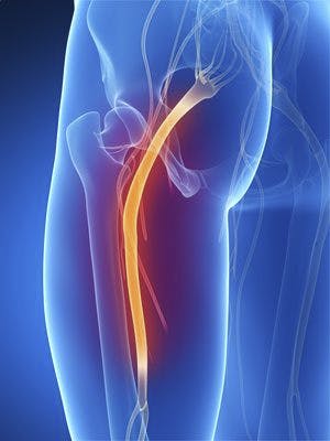 Sciatica Physical Therapy