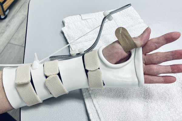 Hand Splint | Custom Splinting