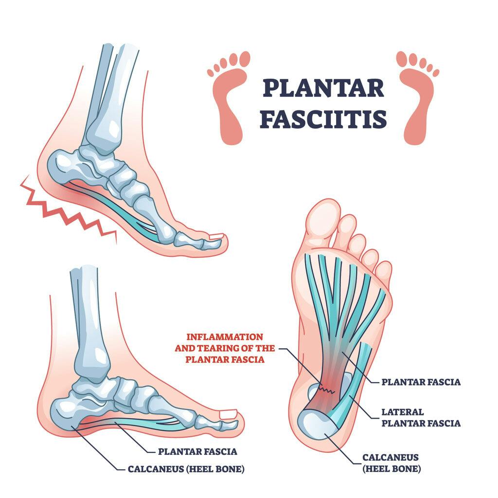 4 foot injuries to watch out for while running