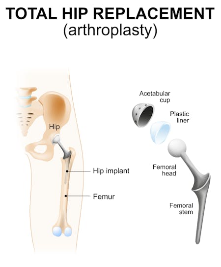 Total Hip Replacement including blow-apart view of implant/prosthesis