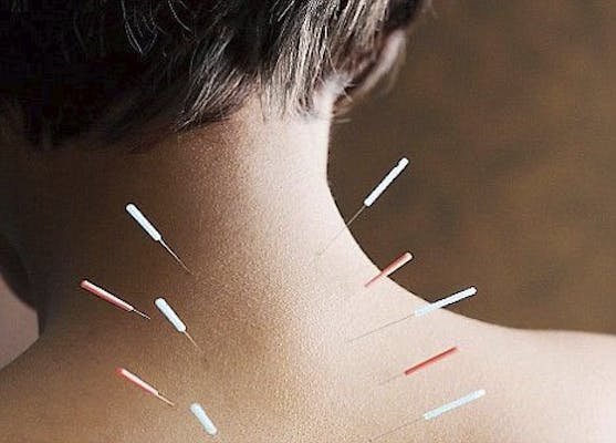 Dry Needling, Our Services