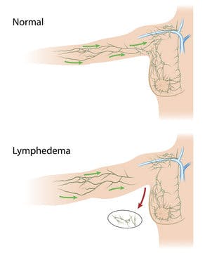 Lymphedema in the arm