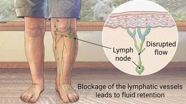 Lymphedema ulcers in the leg