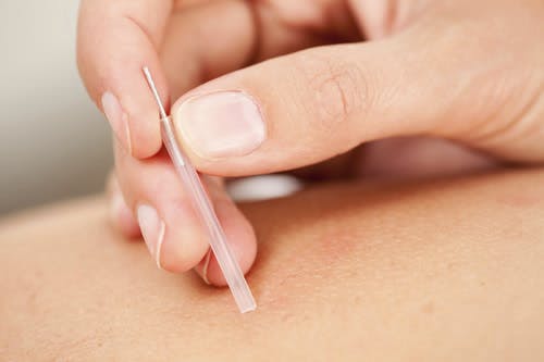  Benefits of Acupuncture