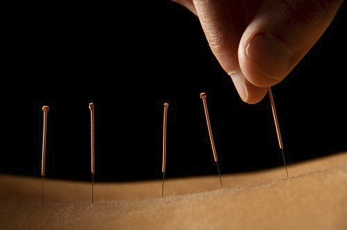 How Acupuncture Helps Manage Holiday Stress