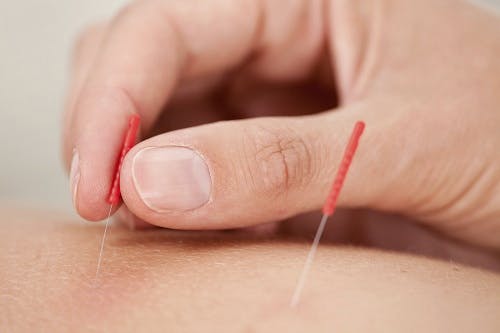 How Acupuncture Helps Manage Holiday Stress
