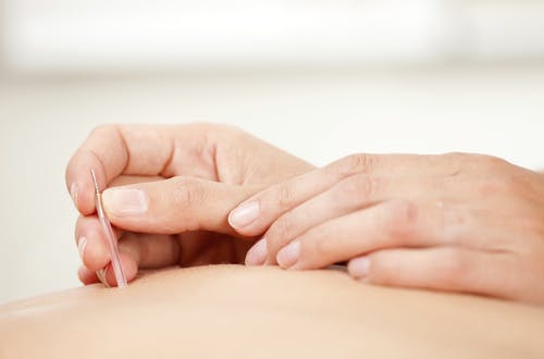  Benefits of Acupuncture