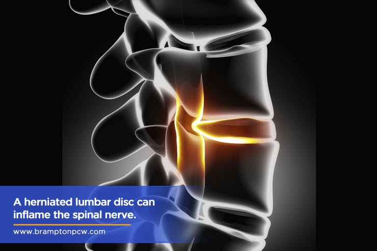 A-herniated-lumbar-disc-can-inflame-the-spinal-nerve