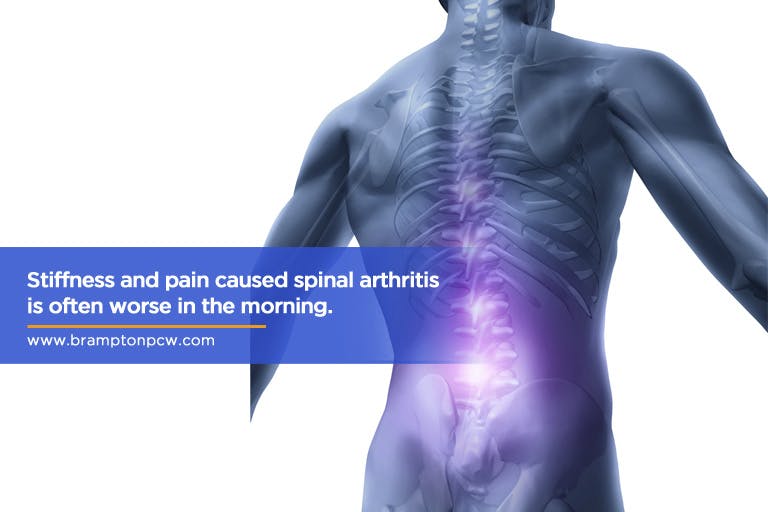 Stiffness-and-pain-caused-spinal-arthritis-is-often-worse-in-the-morning