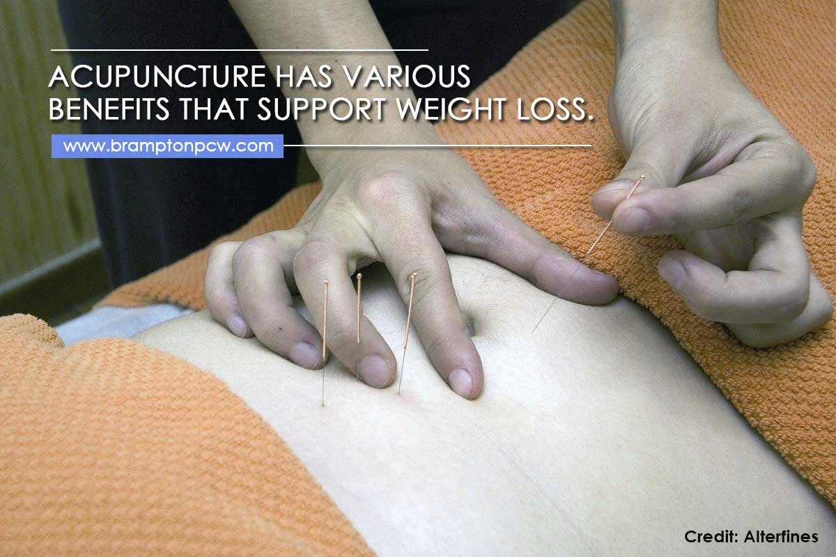 Can Acupuncture Help You Lose Weight? 