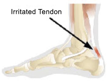 Jump Start Physical Therapy | Achilles Tendinitis | Natick | Norwood | Newton
