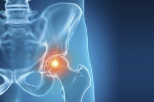 Recovering from Piriformis Syndrome, Deep Gluteal Syndrome or Hip Related  Sciatica - Hip Pain Help