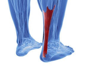 physiotherapy for achilles tendonitis