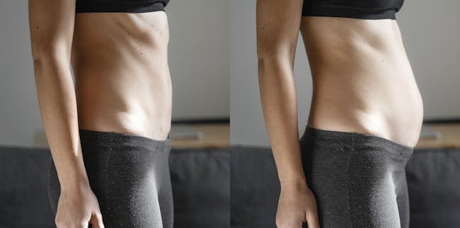 What Is A Diastasis Recti And How Do I Fix It? - National