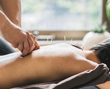 Chesapeake Bay Aquatic & Physical Therapy's dry needling treatment service.