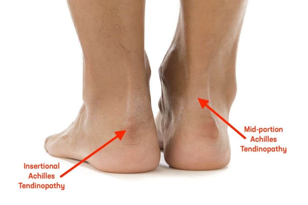 Achilles clearance tendinitis insertional