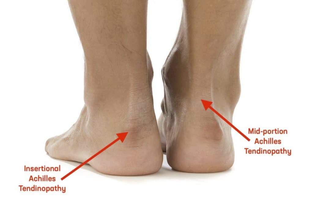 Stretches for achilles tendon problems