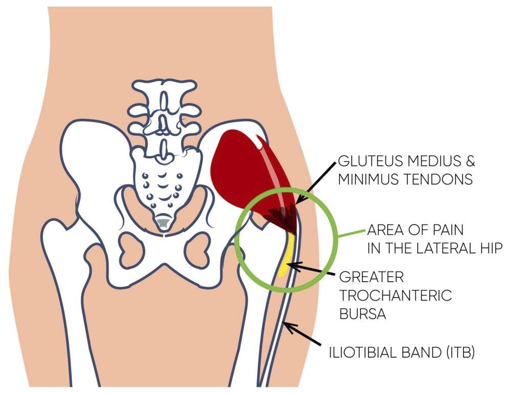 Gluteus Medius Pain - What It Feels Like And How To Fix It