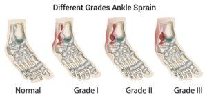 Grades of lateral ankle sprain