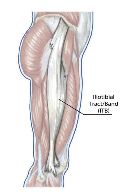 Iliotibial Band Syndrome: A Common Source of Knee Pain