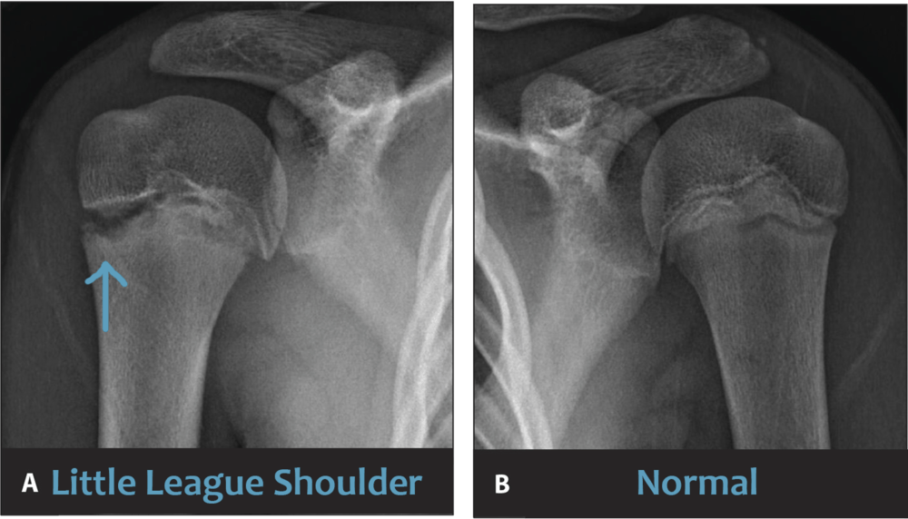Little League shoulder x-ray