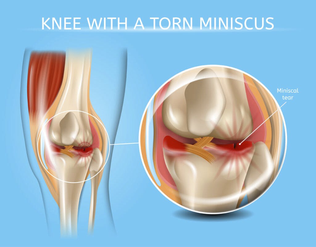 Meniscus of knee