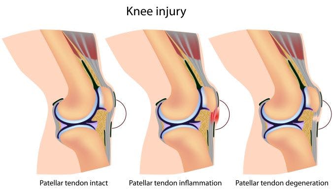 Leg extensions best sale for patellar tendonitis