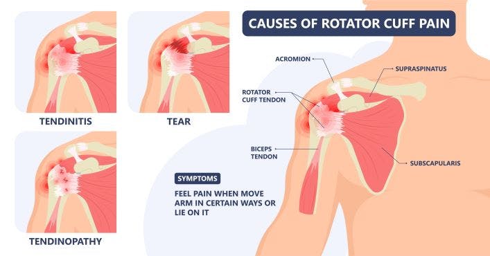 Rotator cuff deals tendonitis exercises