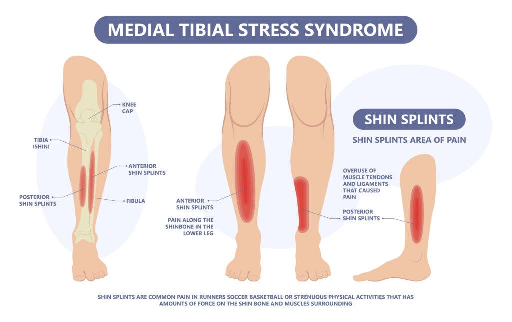 Physical therapy for shin splints