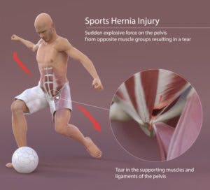 sports hernia treatment