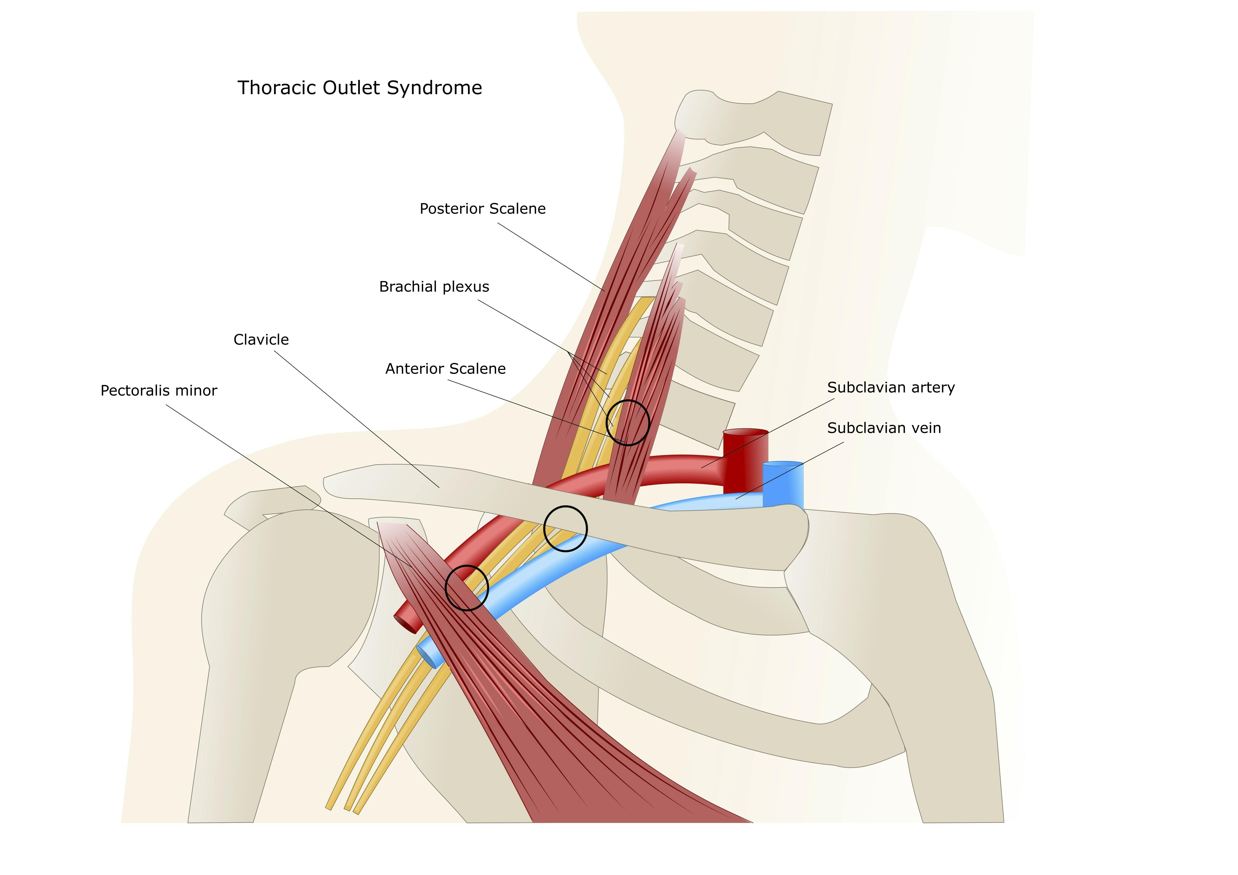Causes of Venous Thoracic Outlet Syndrome • Thoracic Outlet Syndrome  Testing, Specialists, Symptoms, Exercises