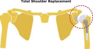 Shoulder replacement surgery