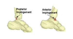 physical therapy for ankle impingement