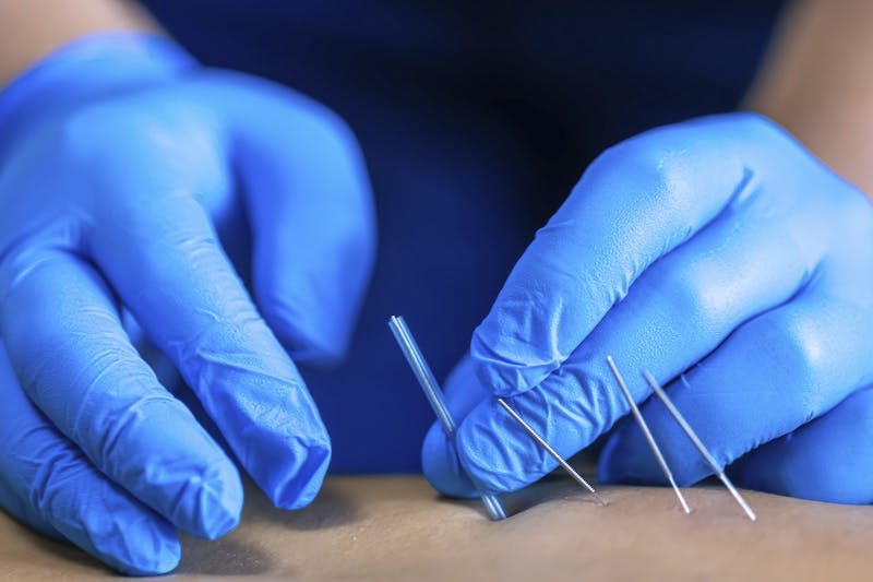 FAQ about Dry Needling