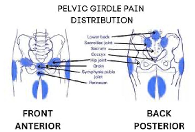 Diagram of Pelvic Girdle Pain (PGP) Distribution