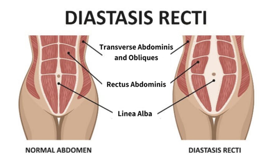 Diagram of Diastasis Recti