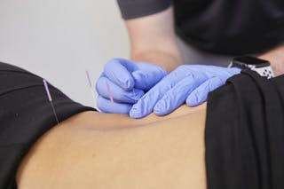 Dry Needling - Physical Therapy & Rehabilitation Associates - Dallas and  Mesquite TX
