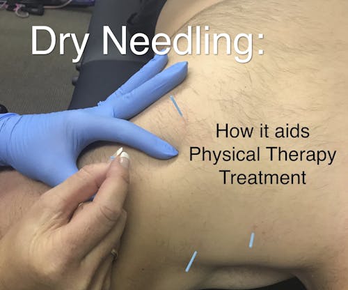 Dry Needling - Physical Therapy & Rehabilitation Associates - Dallas and  Mesquite TX