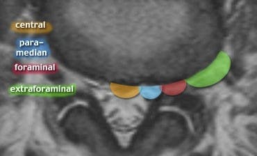 Axial localisation of herniated discs