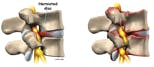 Lumbar Disc Herniation and Disc Degeneration