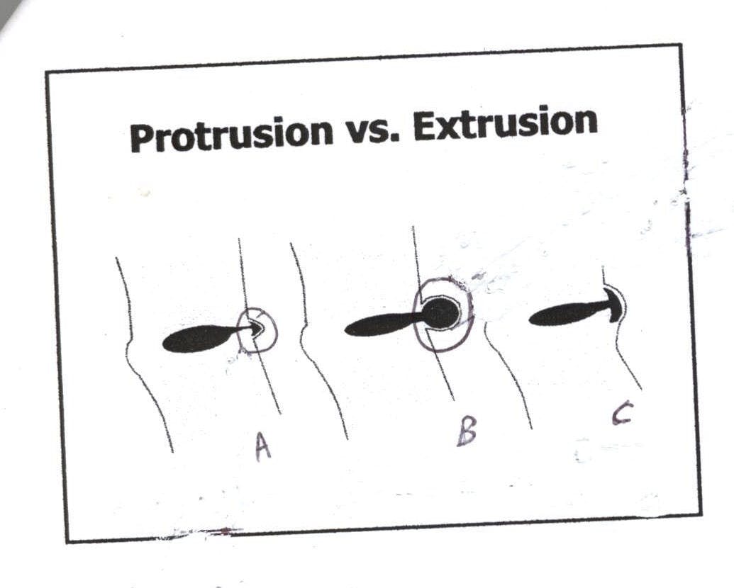 Protrusion vs. Extrusion