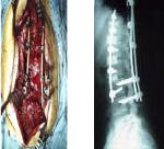 Open Back Surgery/ Lumbar Lateral Surgery