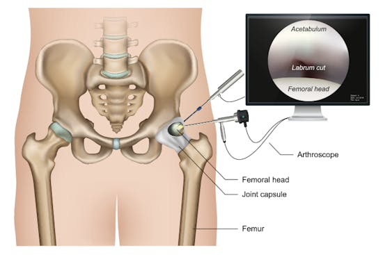 Hip Arthroscopy