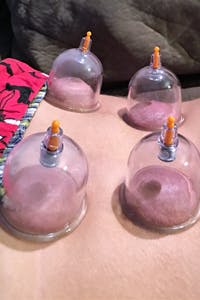 Physical Therapy Professionals | Cupping Therapy | Elkhart | Michiana