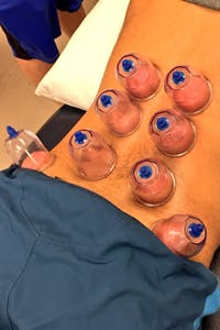 Physical Therapy Professionals | Cupping Therapy | Elkhart | Michiana