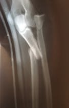 X-Ray of a Fracture