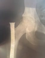 X-Ray showing hardware to fix fracture