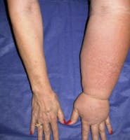 Lymphedema - Side Effects of Cancer Treatment - CDC