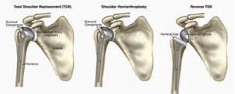 otal Shoulder Replacement vs Reverse Total Shoulder Replacement